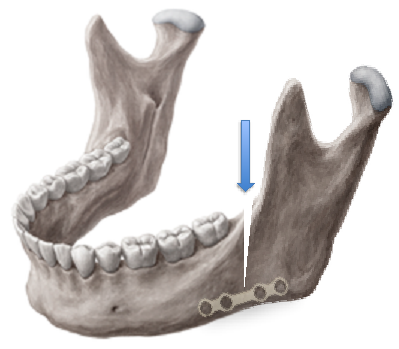 Full mouth Rehabilitation 2